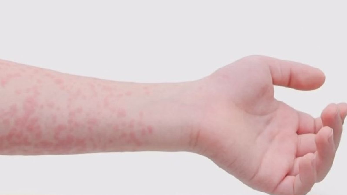 Ya son 8 los casos de sarampión en el condado Wasatch – Telemundo Utah