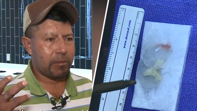 “Vomitaba del dolor”: hispano vivió una pesadilla por una lombriz en su cerebro