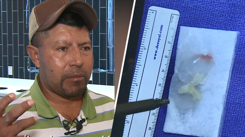“Vomitaba del dolor”: hispano vivió una pesadilla por una lombriz en su cerebro