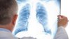 Todo lo que tienes que saber sobre la “neumonía del pulmón blanco”