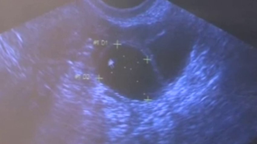 Utah se une a ley contra el aborto