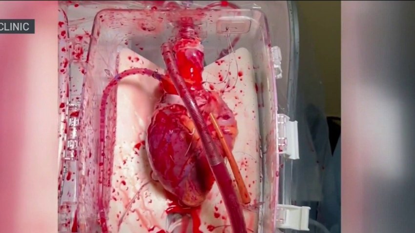 “Corazón en una caja”: nueva tecnología mantiene el órgano “vivo” para facilitar trasplantes