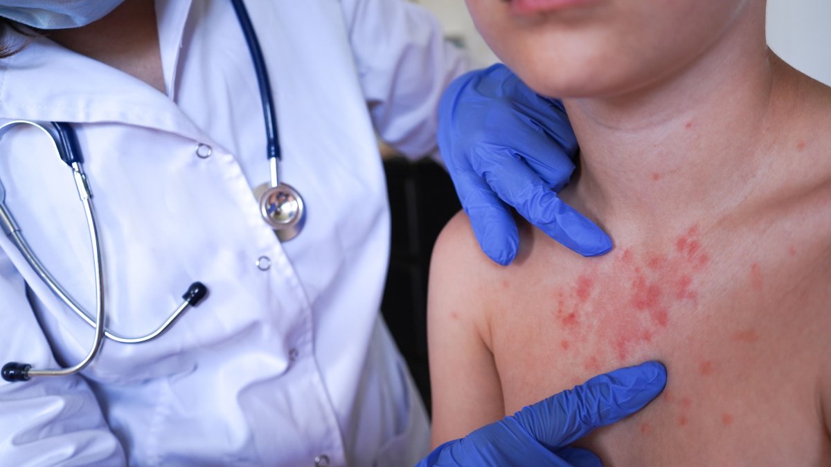 Brote de sarampión en Utah médicos insisten en vacunas – Telemundo Utah