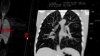 Cáncer de pulmón no relacionado con el tabaquismo